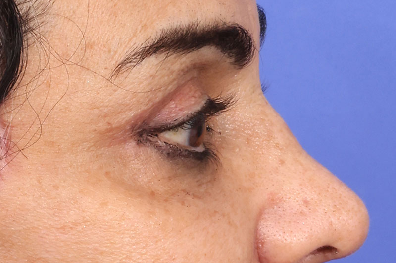 Eyelid Surgery Before & After Image