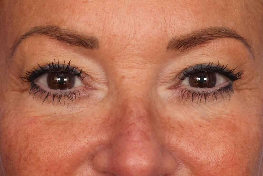 Eyelid Surgery Before & After Image