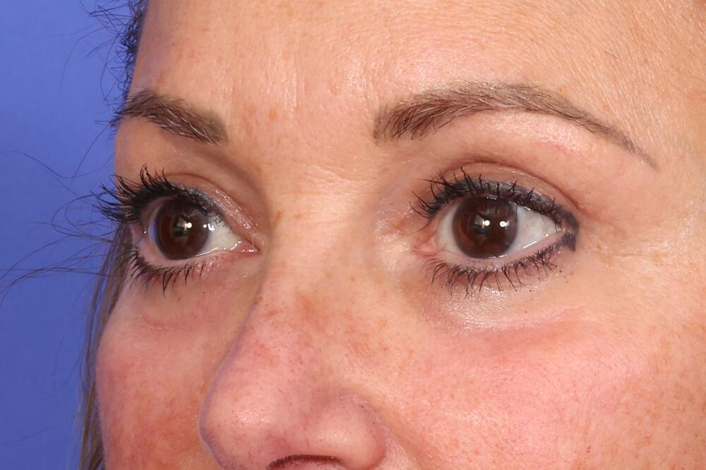 Eyelid Surgery Before & After Image
