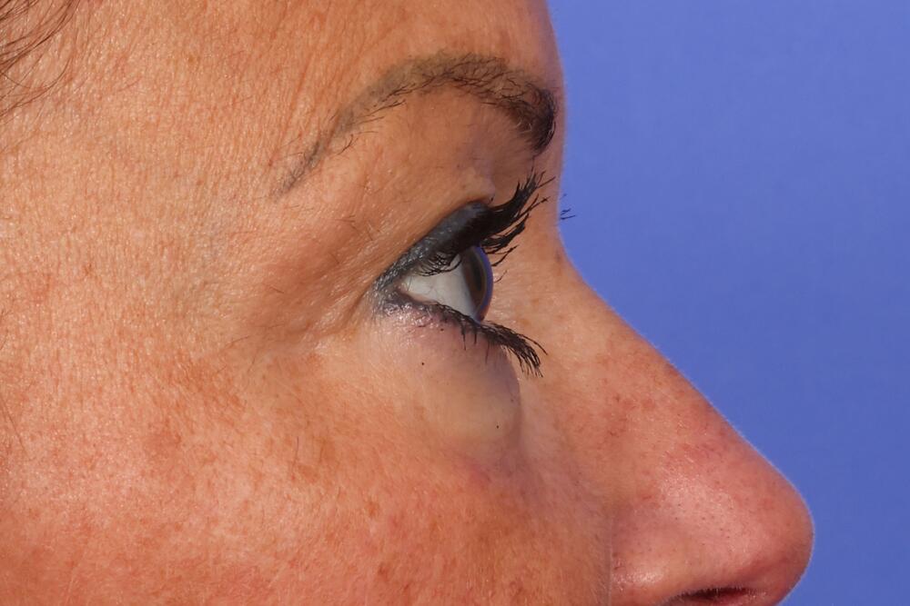 Eyelid Surgery Before & After Image