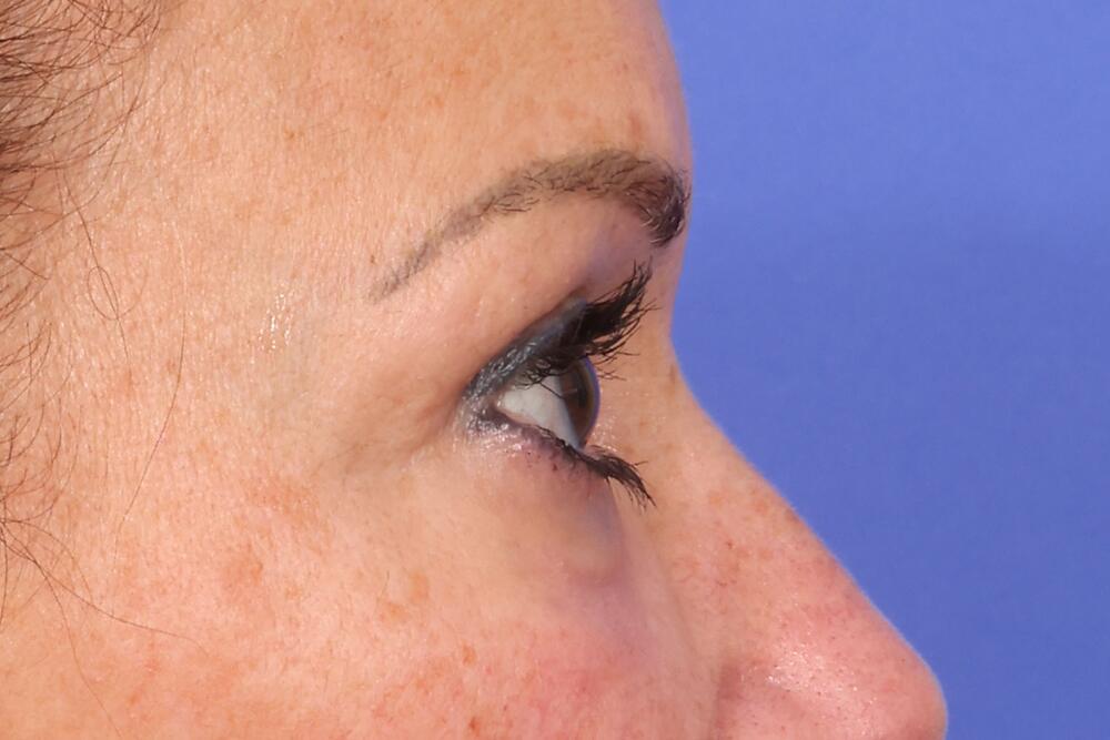Eyelid Surgery Before & After Image