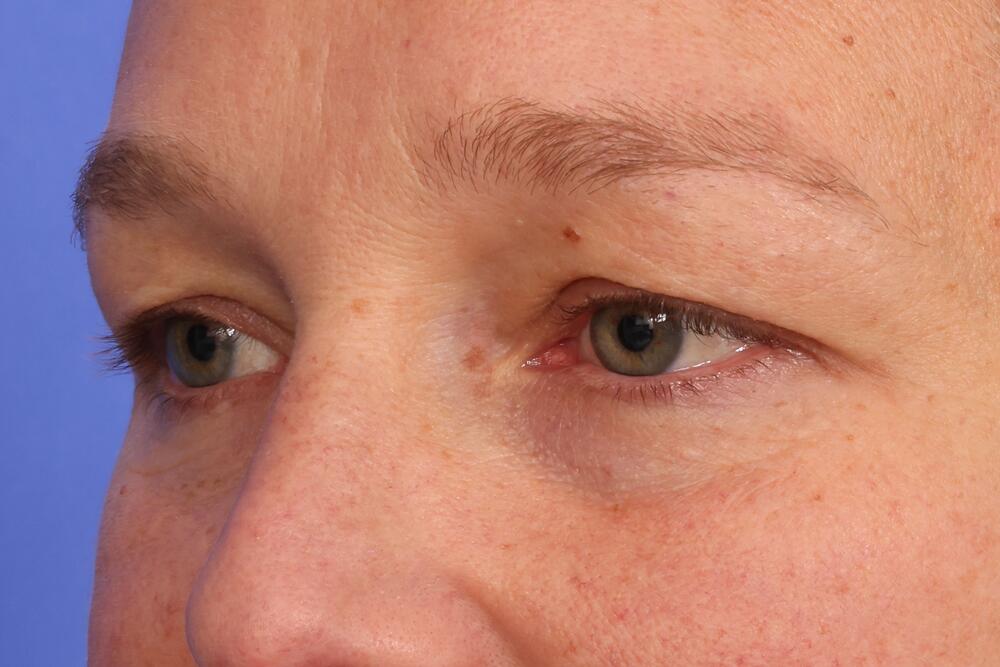 Eyelid Surgery Before & After Image