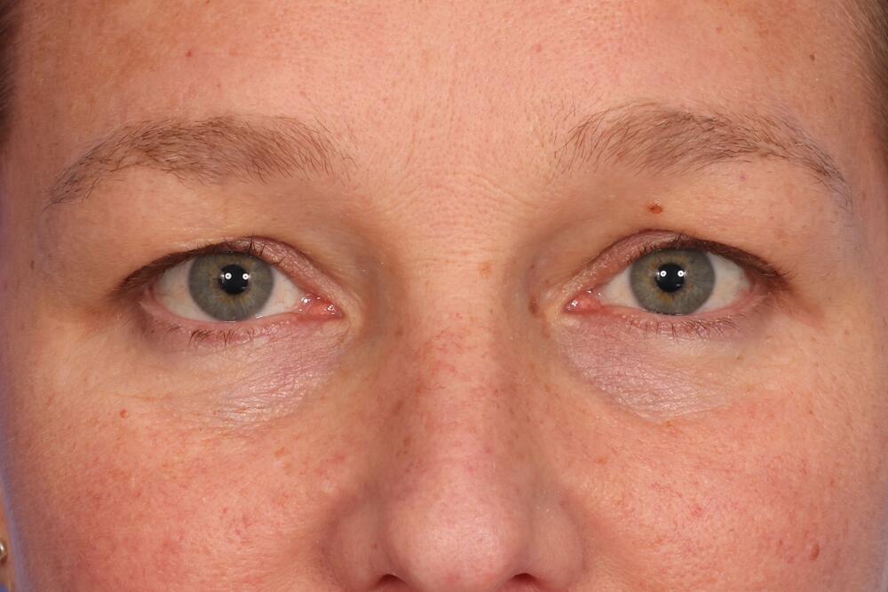 Eyelid Surgery Before & After Image