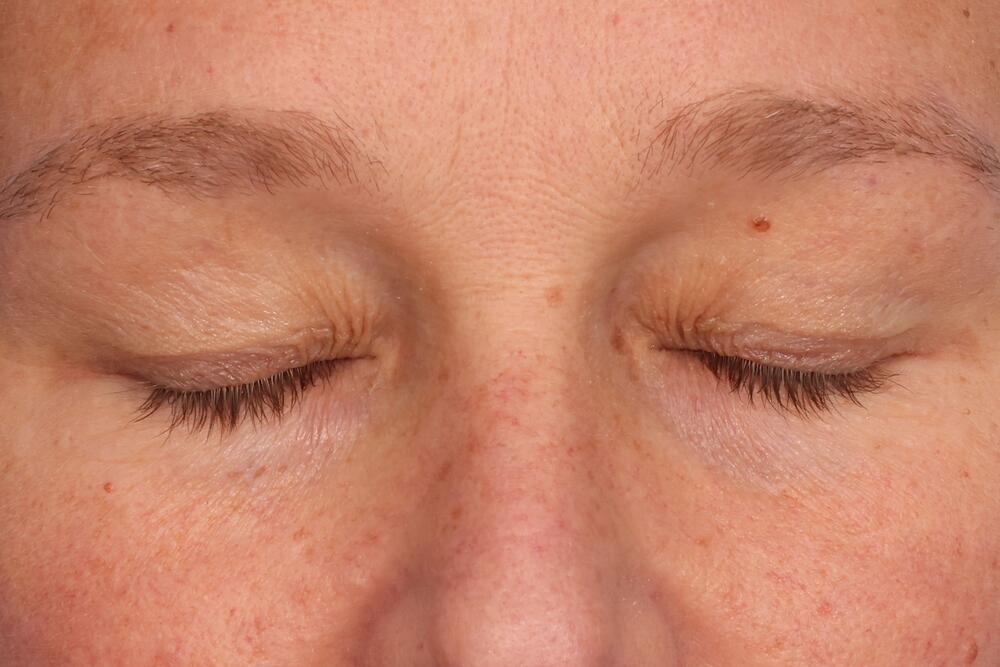 Eyelid Surgery Before & After Image