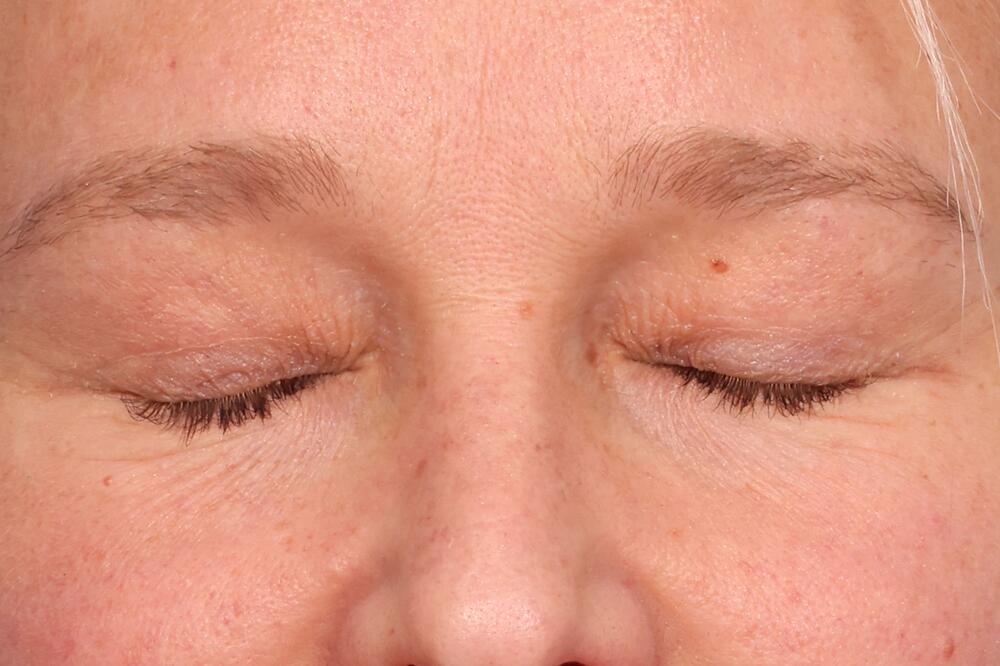 Eyelid Surgery Before & After Image