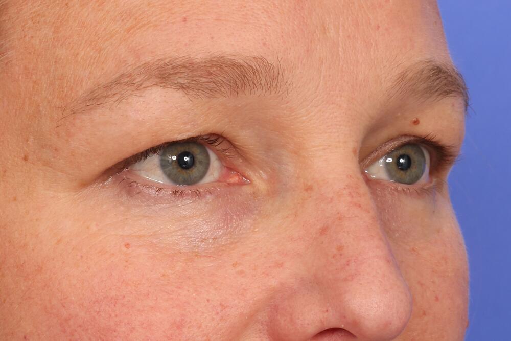 Eyelid Surgery Before & After Image