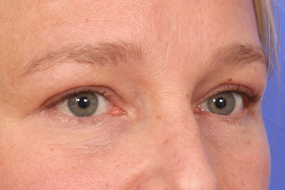 Eyelid Surgery Before & After Image