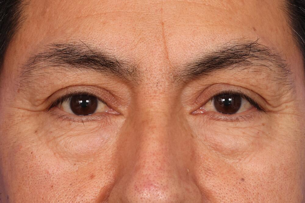 Eyelid Surgery Before & After Image