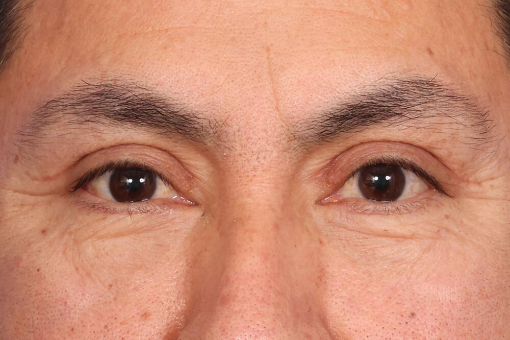 Eyelid Surgery Before & After Image
