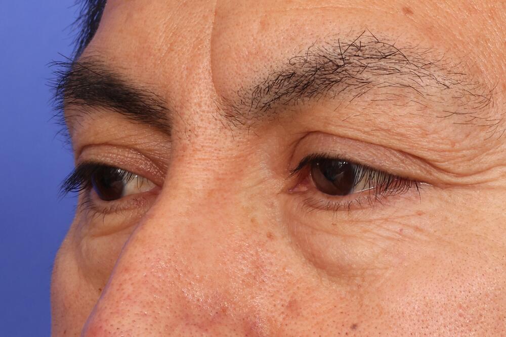 Eyelid Surgery Before & After Image