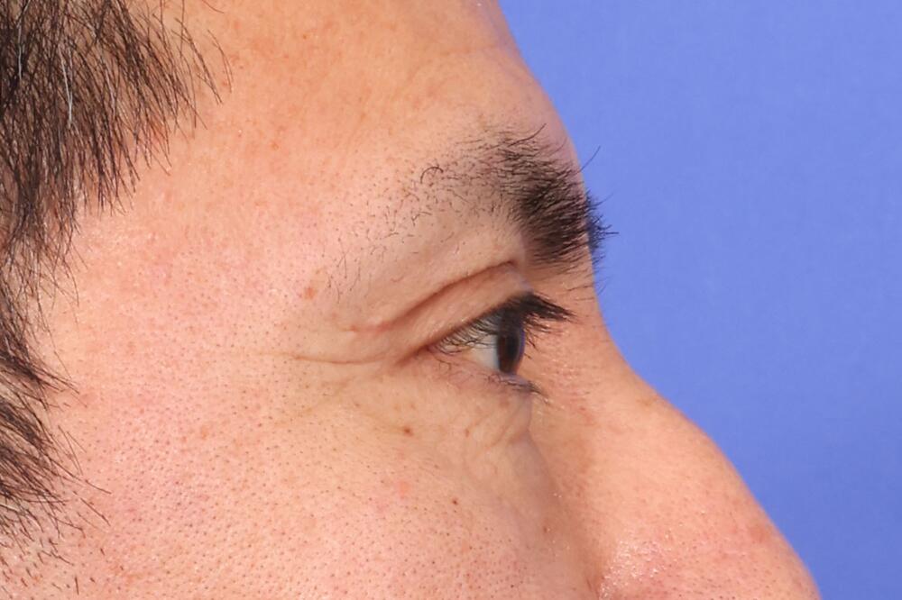 Eyelid Surgery Before & After Image