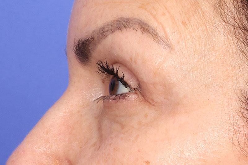 Eyelid surgery Before & After Image