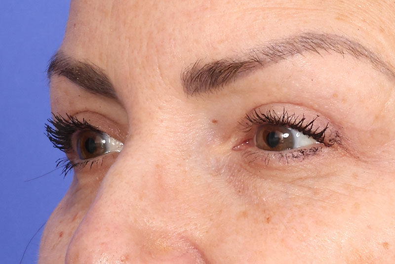 Eyelid Surgery Before & After Image