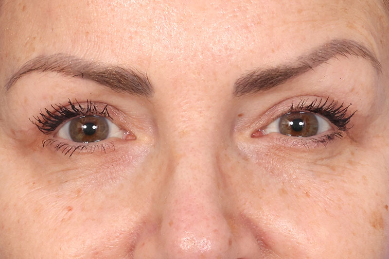 Eyelid Surgery Before & After Image
