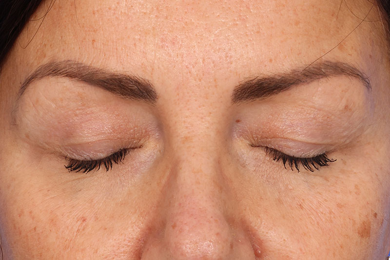 Eyelid Surgery Before & After Image