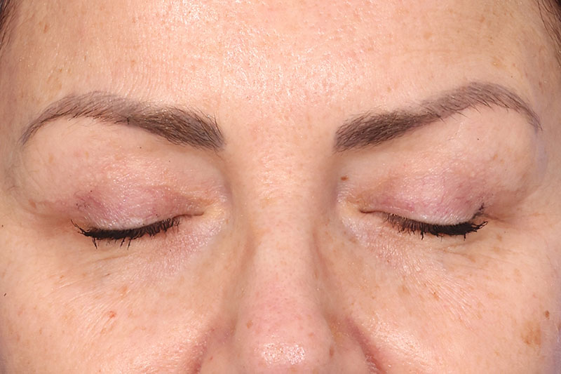 Eyelid Surgery Before & After Image