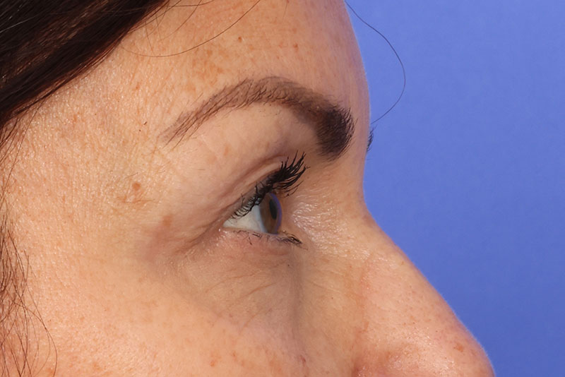 Eyelid Surgery Before & After Image