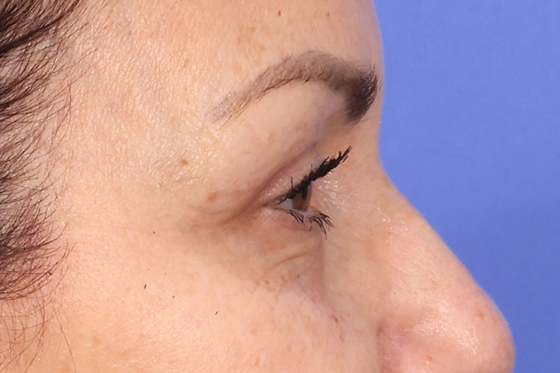 Eyelid Surgery Before & After Image