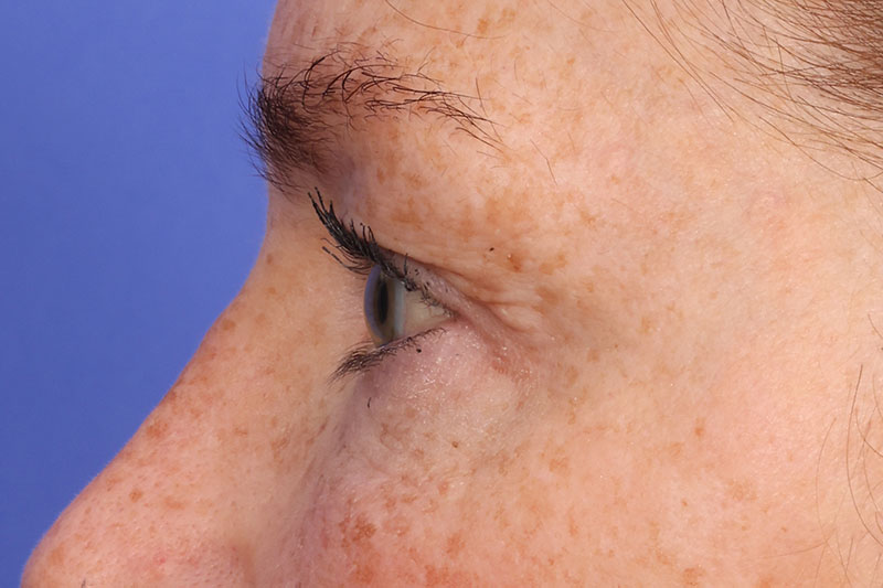 Eyelid surgery Before & After Image
