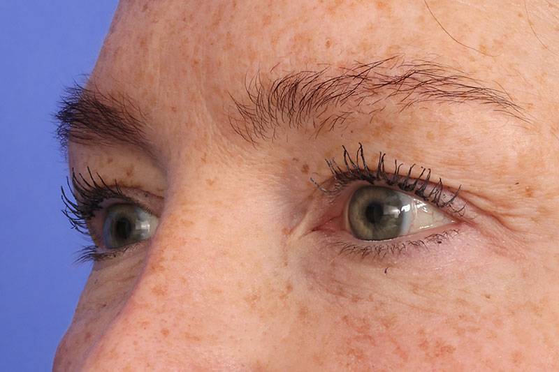 Eyelid Surgery Before & After Image