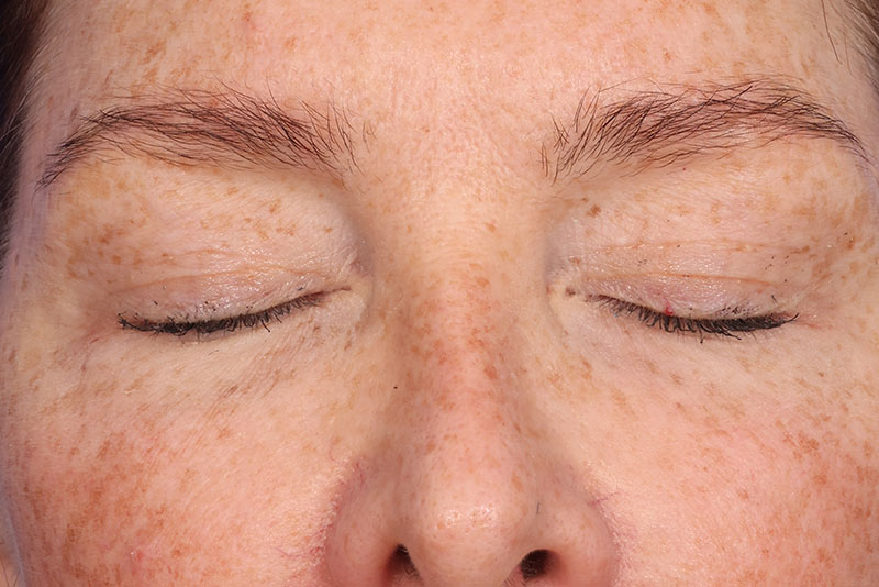 Eyelid Surgery Before & After Image