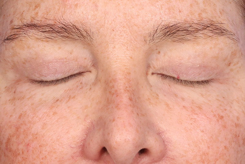 Eyelid Surgery Before & After Image