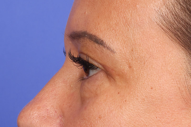 Eyelid Surgery Before & After Image