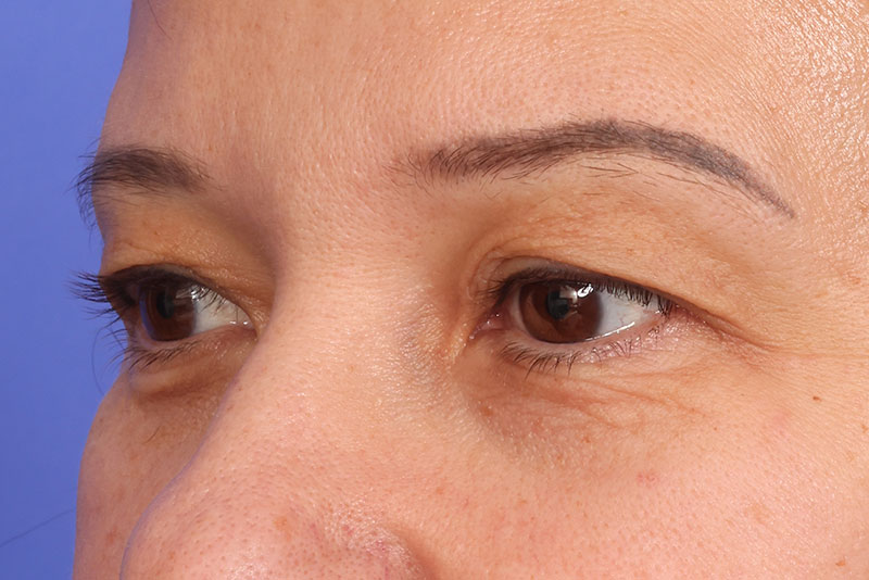Eyelid Surgery Before & After Image