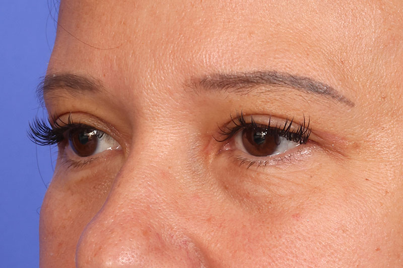 Eyelid Surgery Before & After Image