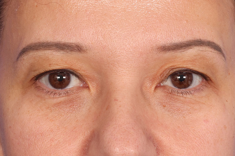 Eyelid Surgery Before & After Image