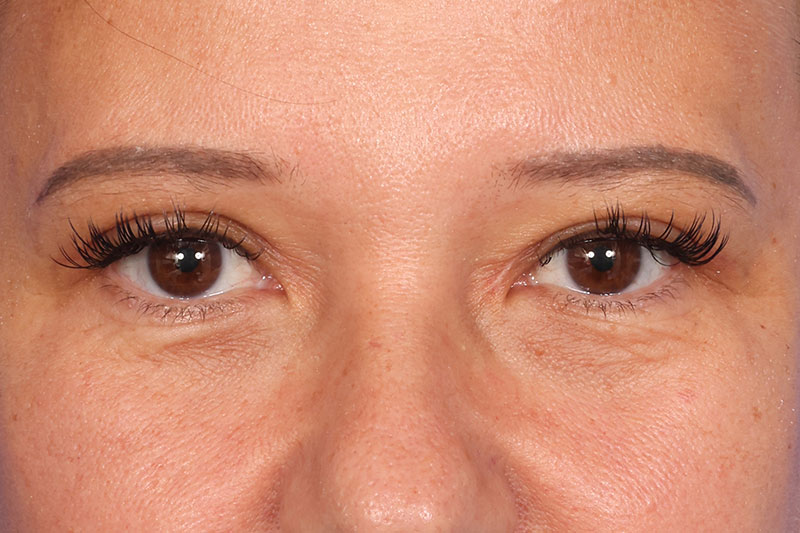 Eyelid Surgery Before & After Image