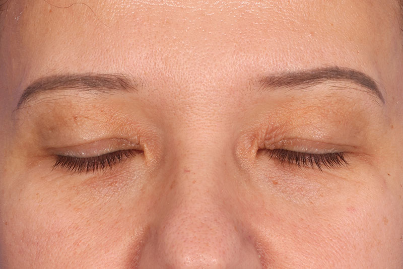 Eyelid Surgery Before & After Image