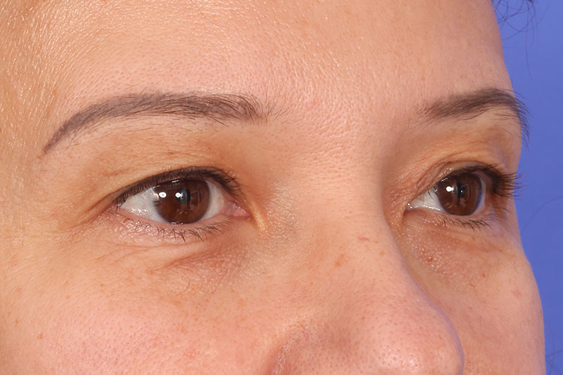 Eyelid Surgery Before & After Image