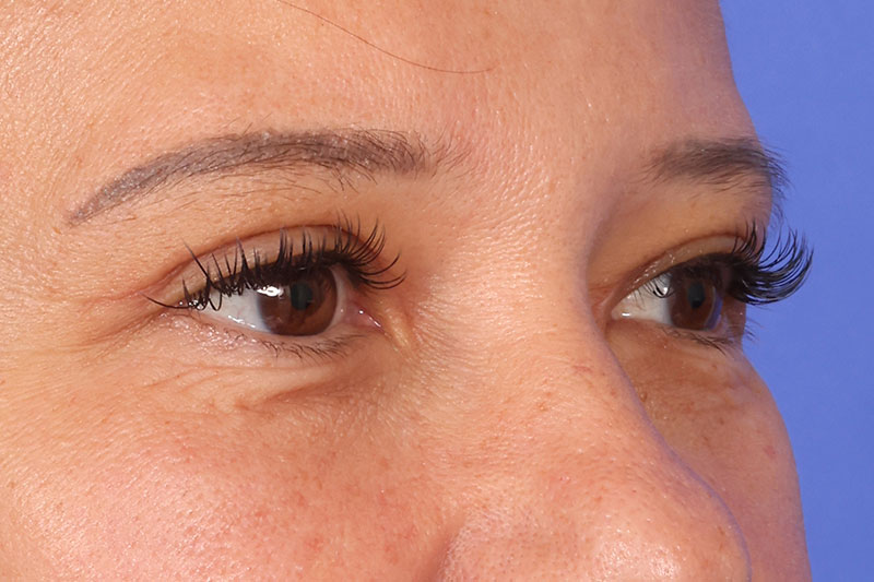 Eyelid Surgery Before & After Image