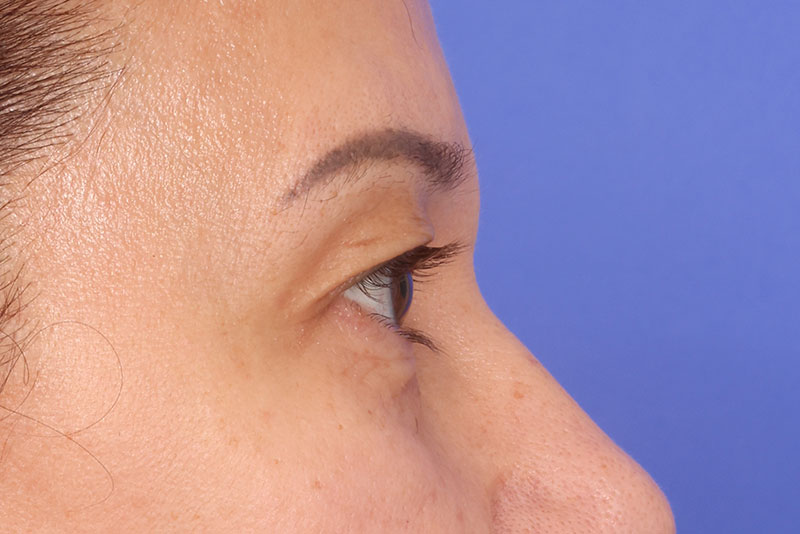 Eyelid Surgery Before & After Image
