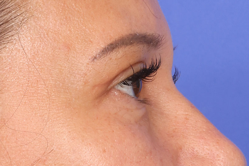 Eyelid Surgery Before & After Image