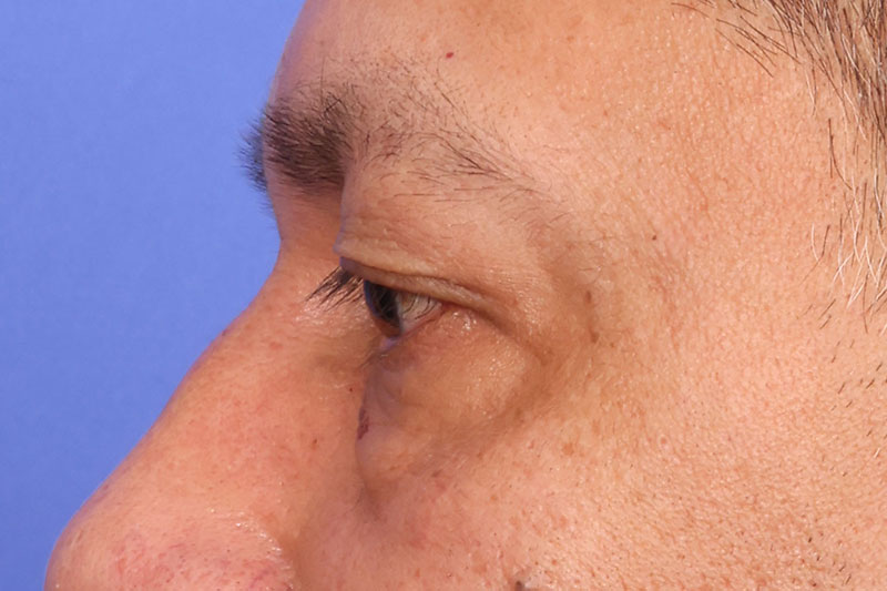 Eyelid surgery Before & After Image