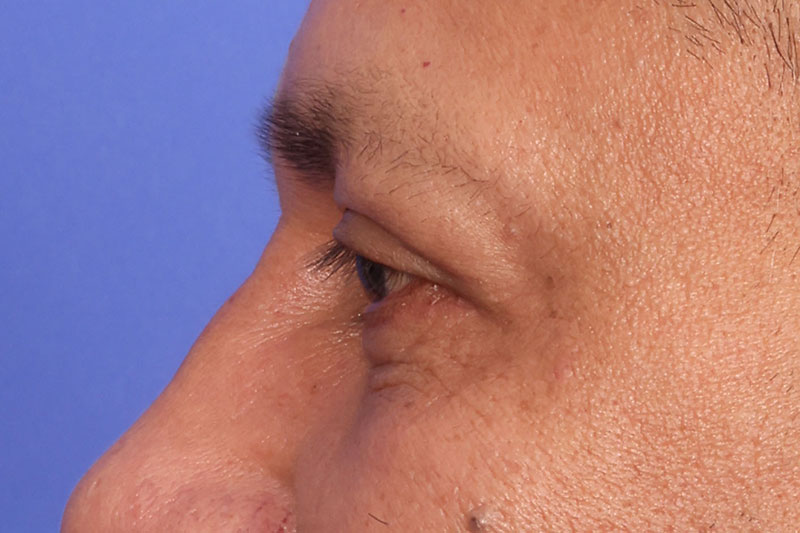 Eyelid surgery Before & After Image