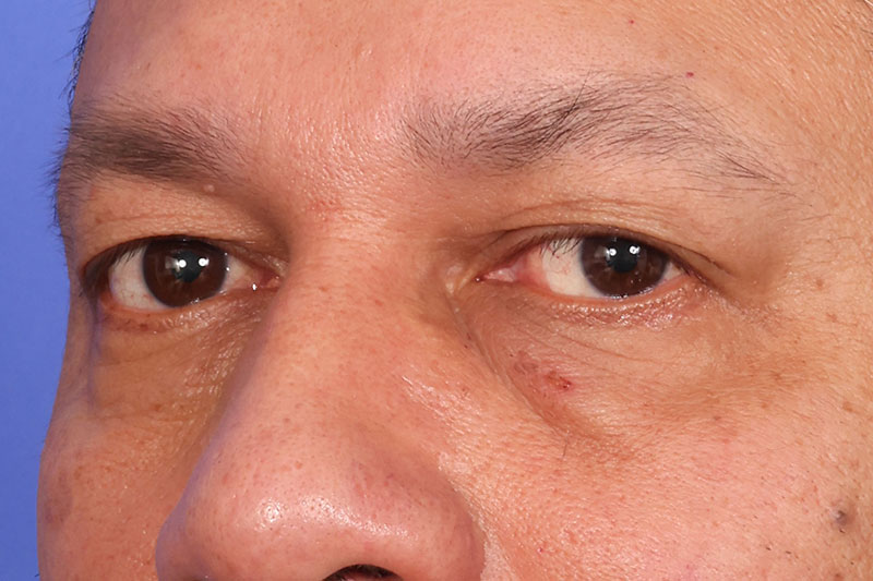 Eyelid Surgery Before & After Image