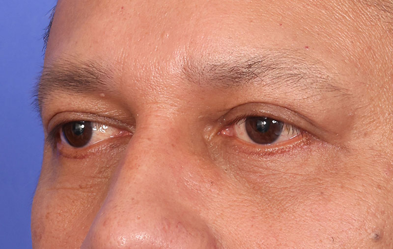 Eyelid Surgery Before & After Image