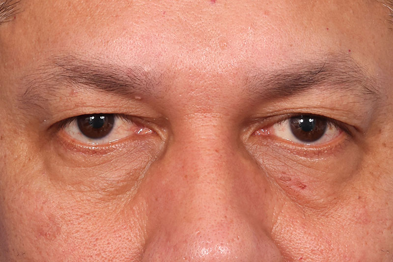 Eyelid Surgery Before & After Image