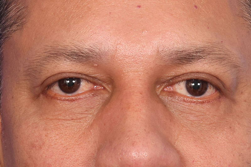 Eyelid Surgery Before & After Image