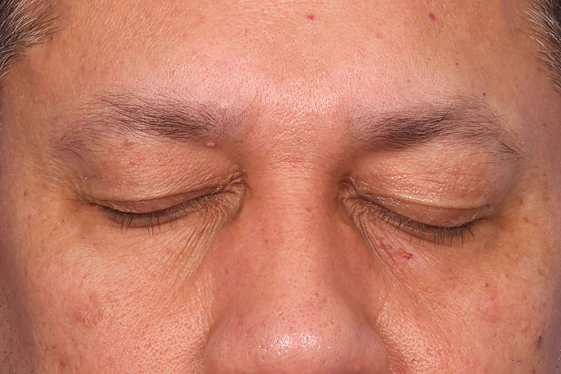 Eyelid Surgery Before & After Image