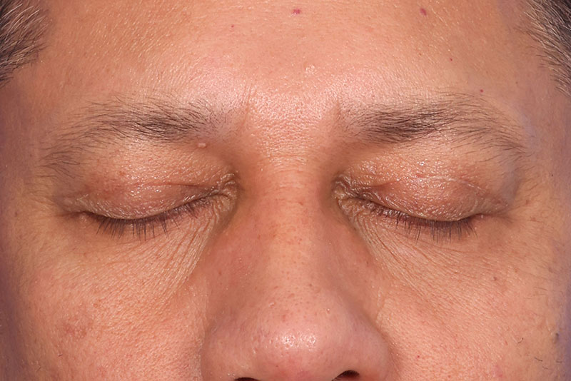 Eyelid Surgery Before & After Image