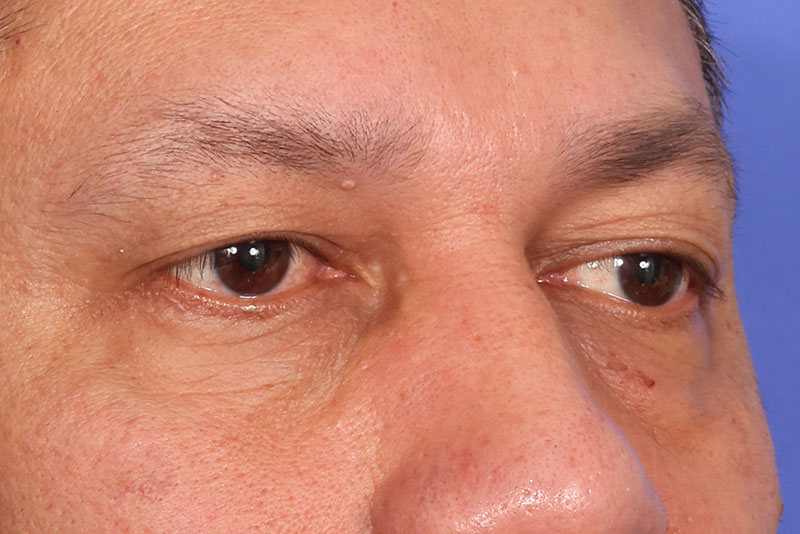 Eyelid Surgery Before & After Image