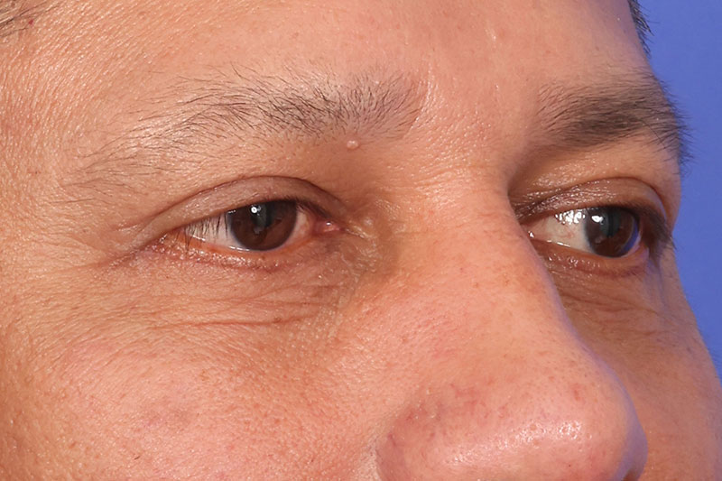 Eyelid Surgery Before & After Image