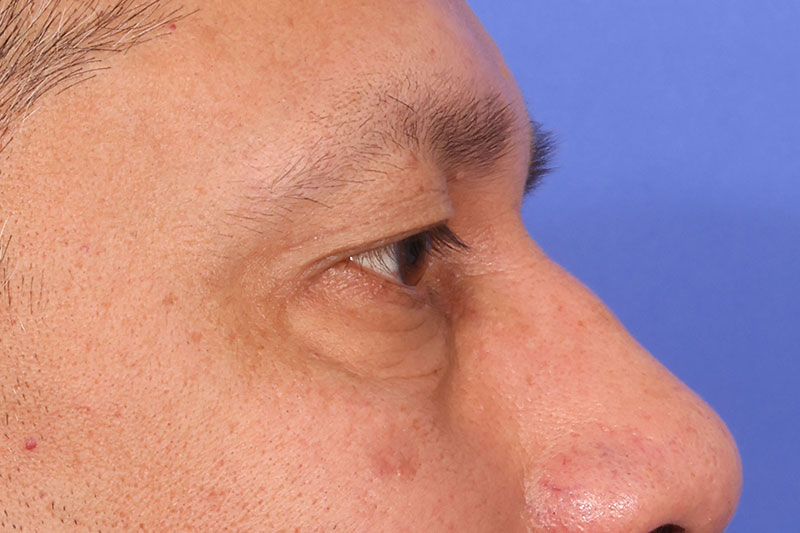 Eyelid Surgery Before & After Image