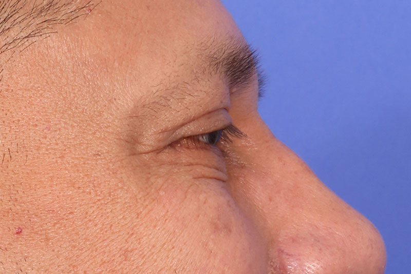 Eyelid Surgery Before & After Image