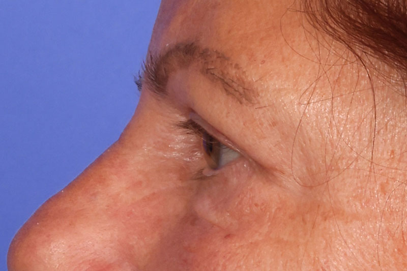 Eyelid Surgery Before & After Image
