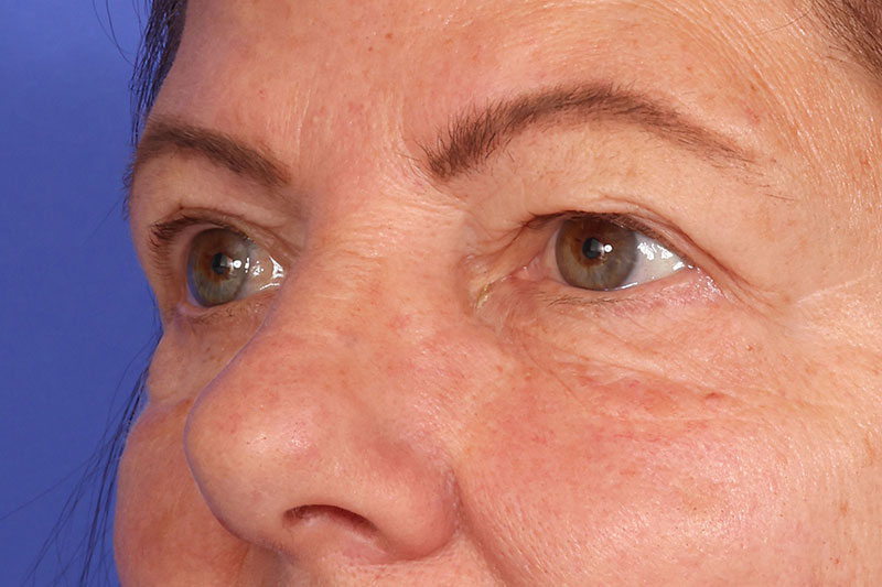 Eyelid Surgery Before & After Image